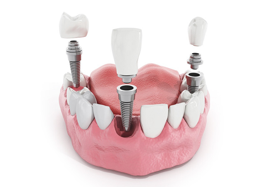 Цена имплантации 1 зуба